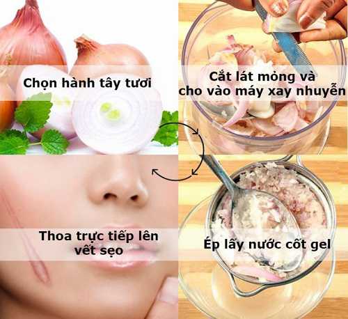 Làm mờ sẹo lồi hiệu quả bằng chiết xuất hành tây và mật ong Làm mờ sẹo lồi hiệu quả bằng chiết xuất hành tây và mật ong
