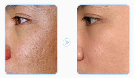 Chữa sẹo sớm dễ thành công hơn khi để lâu