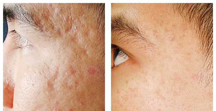 Hiệu quả cả đối với những vết sẹo rỗ cũ