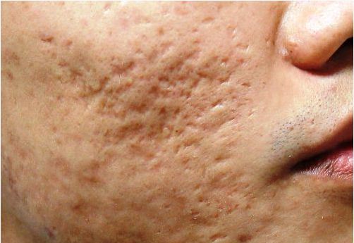 Sẹo rỗ do mụn