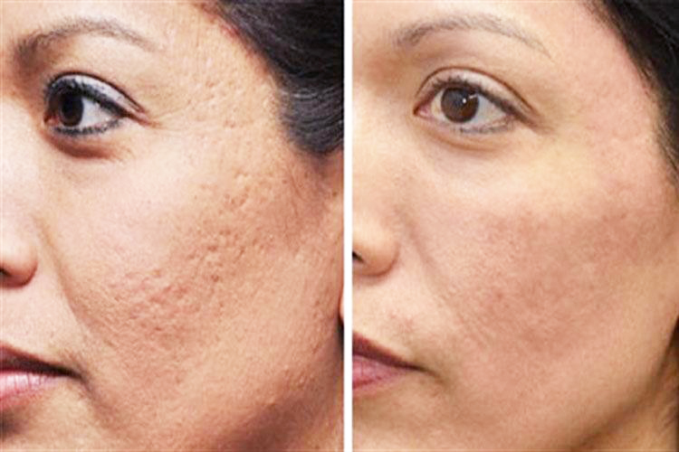 Mang đến hiệu quả cải thiện sẹo rỗ nhanh chóng