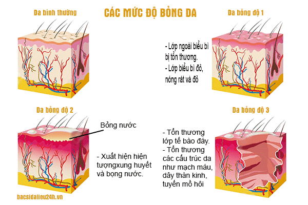 Bỏng thường được phân loại thành 3 mức độ chính