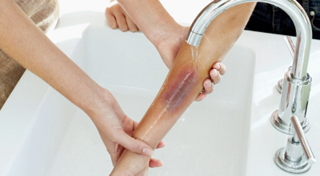 Bỏng cấp độ 2 là trường hợp gây ảnh hưởng đến sức khỏe và có khả năng để lại sẹo