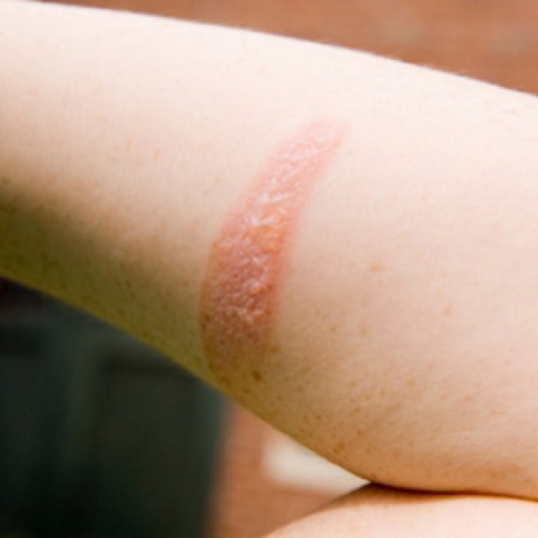 Bỏng cấp độ 1 có thể xử trí ngay tại nhà và không để lại sẹo