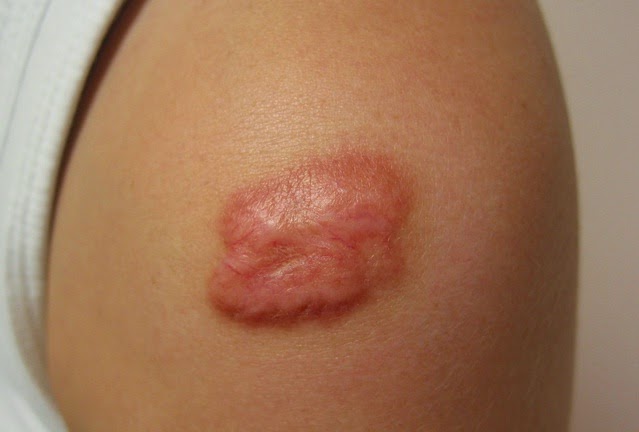 Mách bạn cách làm mờ sẹo lồi bằng hành tây hiệu quả bất ngờ Mách bạn cách làm mờ sẹo lồi bằng hành tây hiệu quả bất ngờ