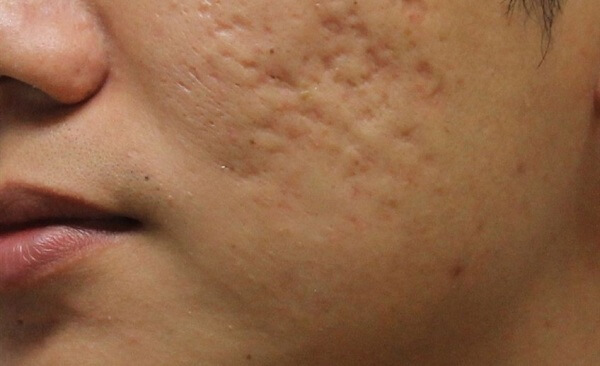 Dầu dừa là một trong những nguyên liệu làm mờ sẹo rỗ rất hiệu quả