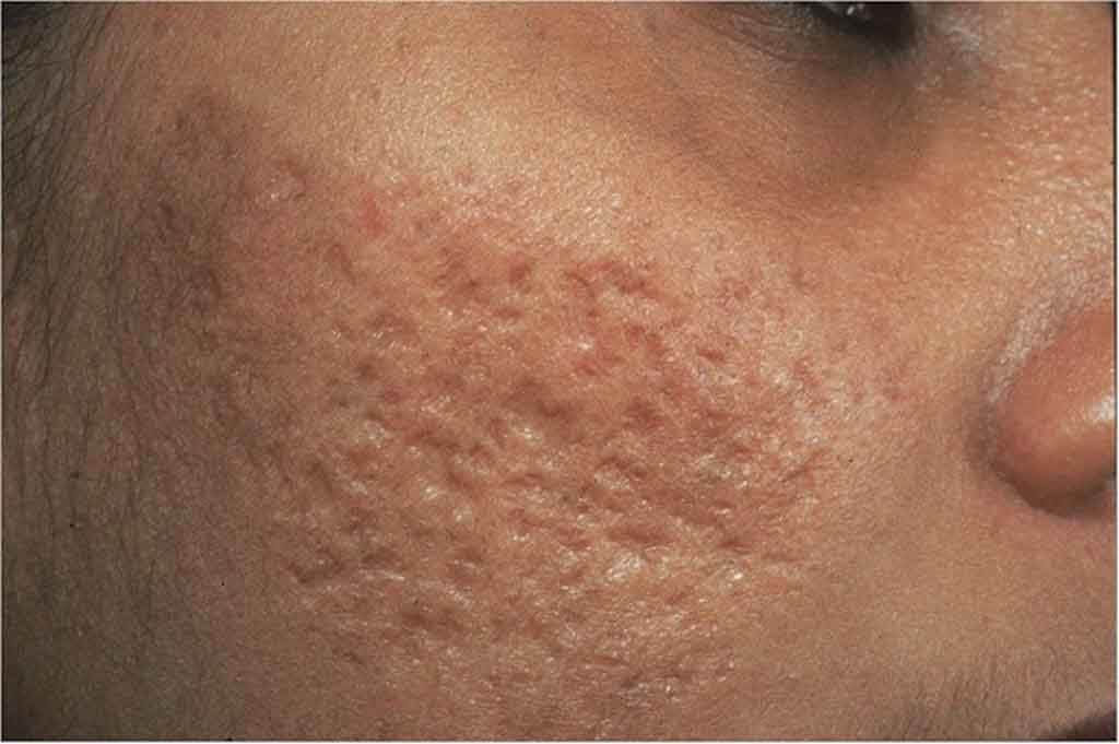 Trường hợp sẹo rỗ quá nặng cần sử dụng các sản phẩm đặc trị