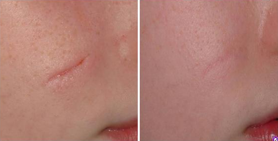 Hiệu quả đáng lấp đầy sẹo rỗ đáng kinh ngạc của kem làm mờ sẹo Esthetique