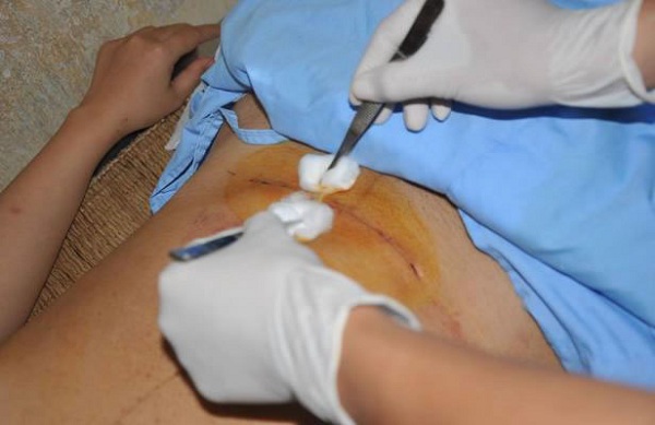 Vết mổ sau sinh bao lâu thì lành, chăm sóc và làm mờ sẹo mổ như thế nào hình ảnh 3 Vết mổ sau sinh bao lâu thì lành, chăm sóc và làm mờ sẹo mổ như thế nào hình ảnh 3