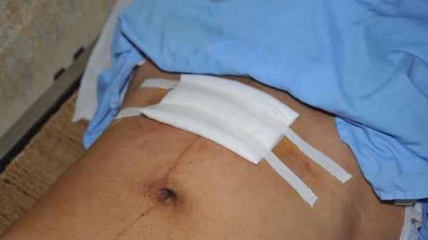 Vết mổ sau sinh bao lâu thì lành, chăm sóc và làm mờ sẹo mổ như thế nào? Vết mổ sau sinh bao lâu thì lành, chăm sóc và làm mờ sẹo mổ như thế nào?